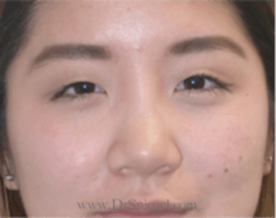 Monolid/Double Eyelid Surgery Before & After Gallery - Patient 813326 - Image 1