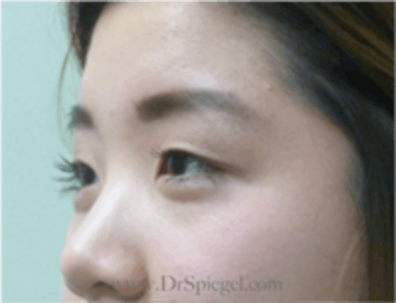 Blepharoplasty Before & After Gallery - Patient 143545 - Image 3