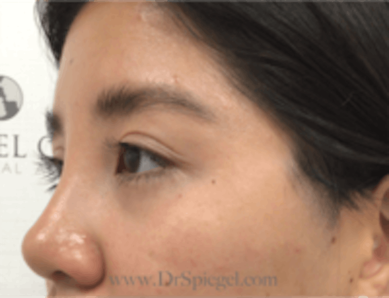 Blepharoplasty Before & After Gallery - Patient 143545 - Image 4