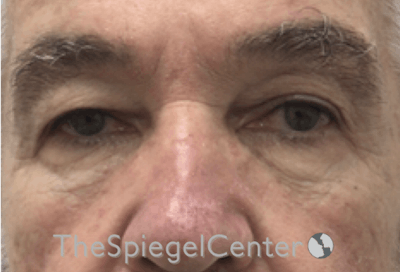 Blepharoplasty Before & After Gallery - Patient 698543 - Image 1