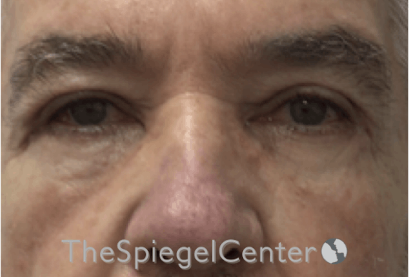 Blepharoplasty Before & After Gallery - Patient 698543 - Image 2