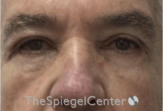 Blepharoplasty Before & After Gallery - Patient 698543 - Image 2