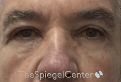 Blepharoplasty Before & After Gallery - Patient 698543 - Image 2