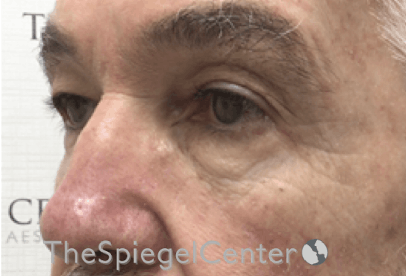 Blepharoplasty Before & After Gallery - Patient 698543 - Image 3