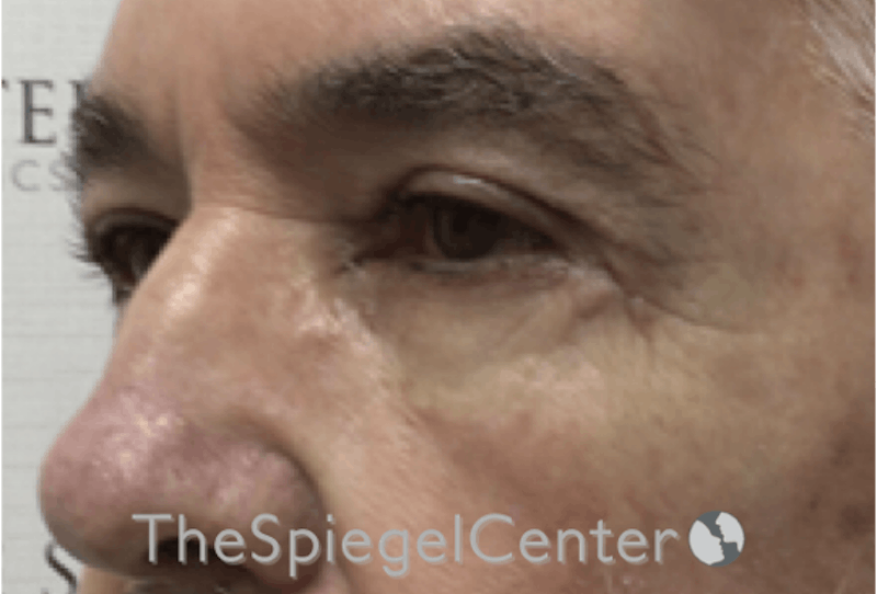 Blepharoplasty Before & After Gallery - Patient 698543 - Image 4