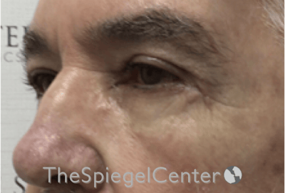 Blepharoplasty Before & After Gallery - Patient 698543 - Image 4