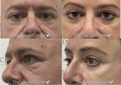 Blepharoplasty Before & After Gallery - Patient 407250 - Image 1