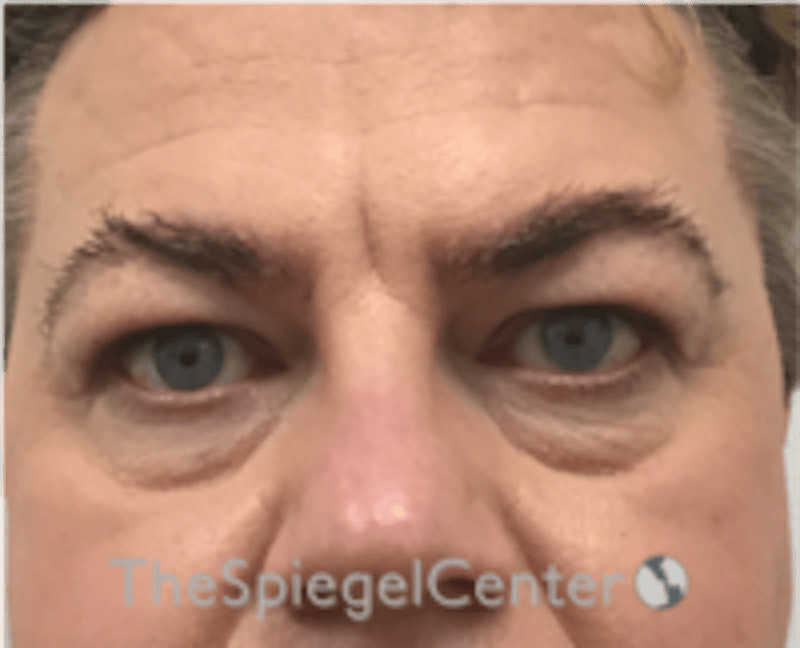 Blepharoplasty Before & After Gallery - Patient 932050 - Image 1