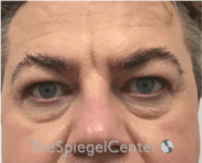 Blepharoplasty Before & After Gallery - Patient 932050 - Image 1