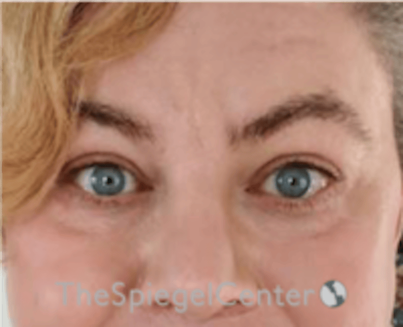 Blepharoplasty Before & After Gallery - Patient 932050 - Image 2