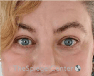 Blepharoplasty Before & After Gallery - Patient 932050 - Image 2