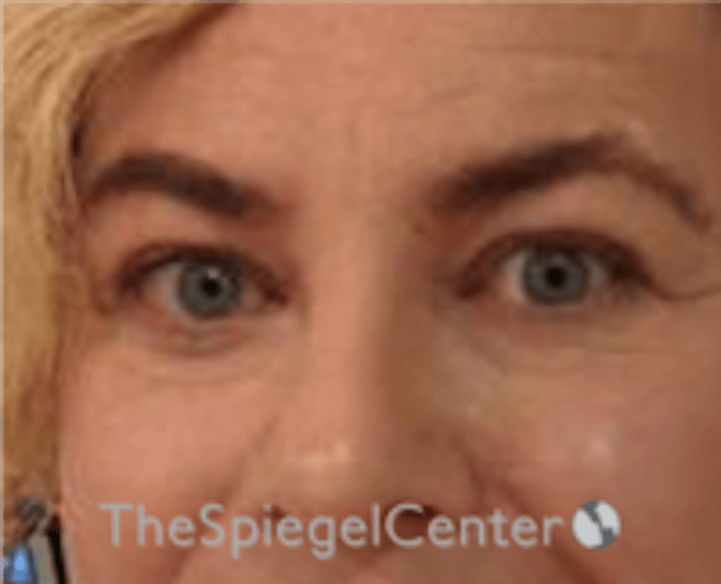 Blepharoplasty Before & After Gallery - Patient 932050 - Image 4