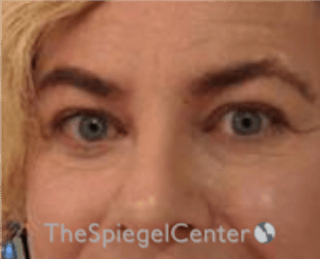 Blepharoplasty Before & After Gallery - Patient 932050 - Image 4