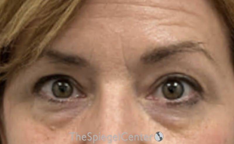 Blepharoplasty Before & After Gallery - Patient 224997 - Image 1