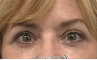 Blepharoplasty Before & After Gallery - Patient 224997 - Image 2