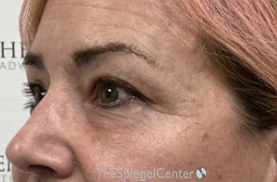 Blepharoplasty Before & After Gallery - Patient 224997 - Image 3