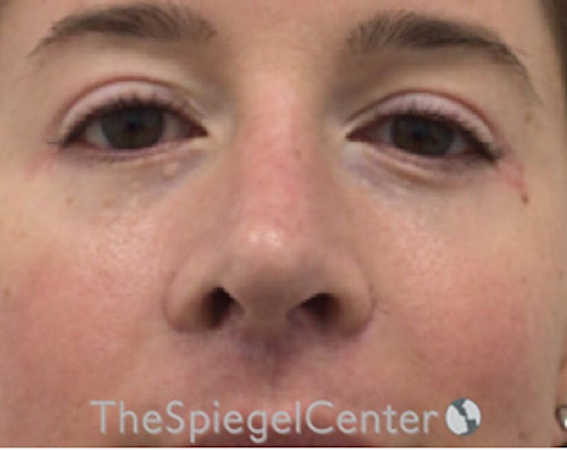 Blepharoplasty Before & After Gallery - Patient 196766 - Image 2