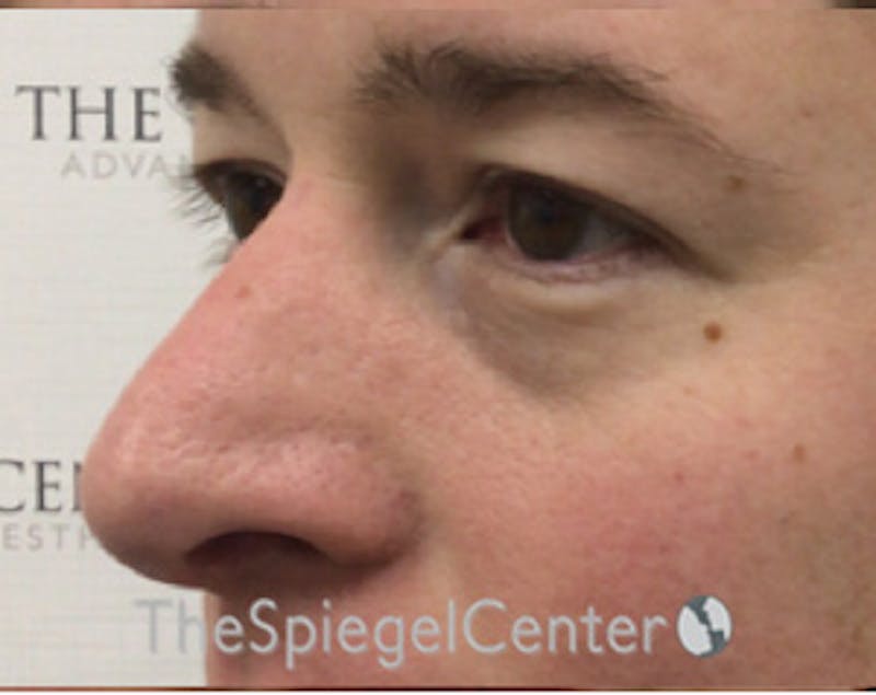 Blepharoplasty Before & After Gallery - Patient 196766 - Image 3