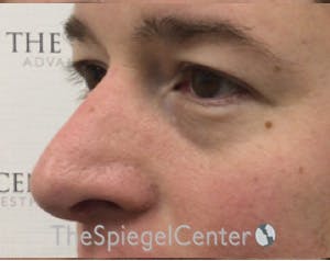 Blepharoplasty Before & After Gallery - Patient 196766 - Image 3