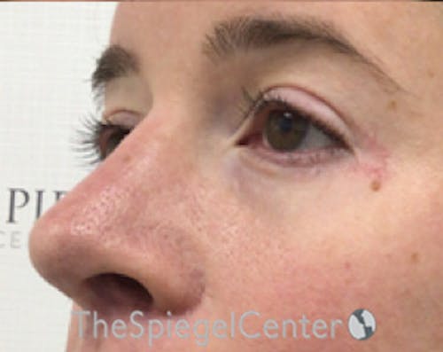 Blepharoplasty Before & After Gallery - Patient 196766 - Image 4