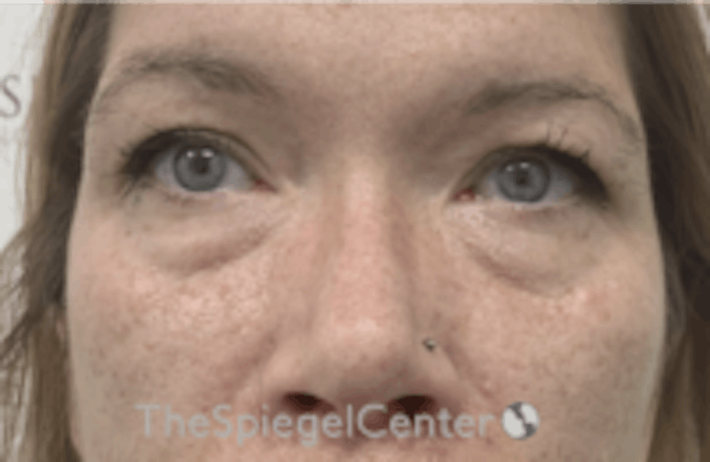 Blepharoplasty Before & After Gallery - Patient 170881 - Image 1