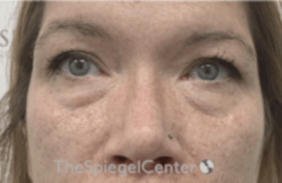 Blepharoplasty Before & After Gallery - Patient 170881 - Image 1