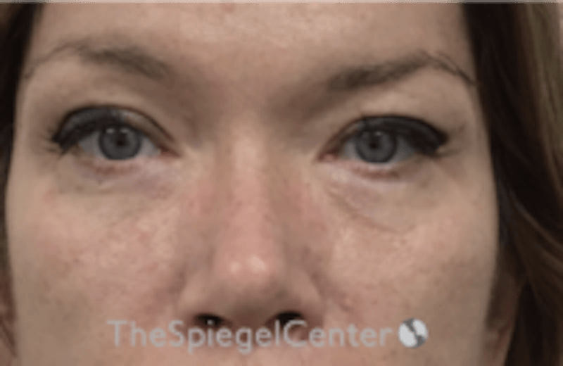 Blepharoplasty Before & After Gallery - Patient 170881 - Image 2