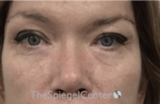Blepharoplasty Before & After Gallery - Patient 170881 - Image 2