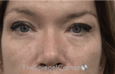 Blepharoplasty Before & After Gallery - Patient 170881 - Image 2