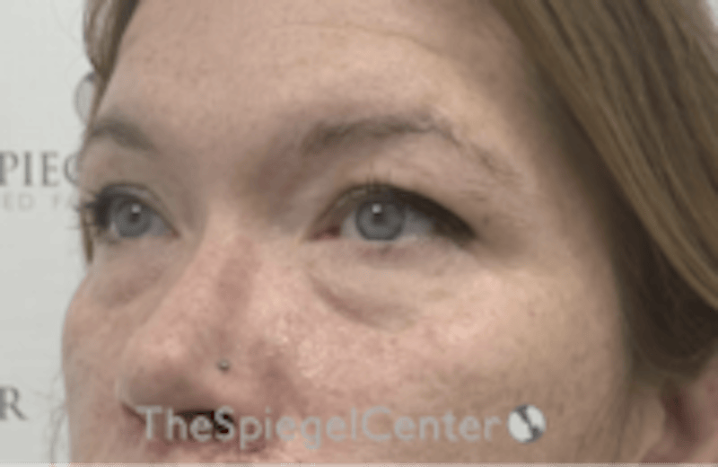 Blepharoplasty Before & After Gallery - Patient 170881 - Image 3