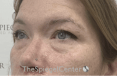 Blepharoplasty Before & After Gallery - Patient 170881 - Image 3