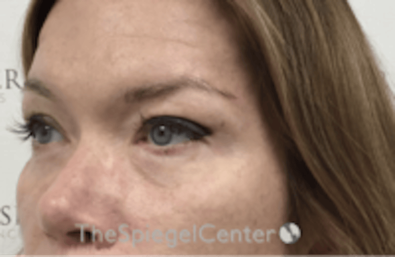 Blepharoplasty Before & After Gallery - Patient 170881 - Image 4