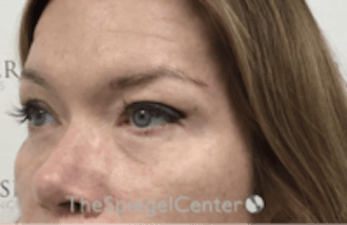 Blepharoplasty Before & After Gallery - Patient 170881 - Image 4