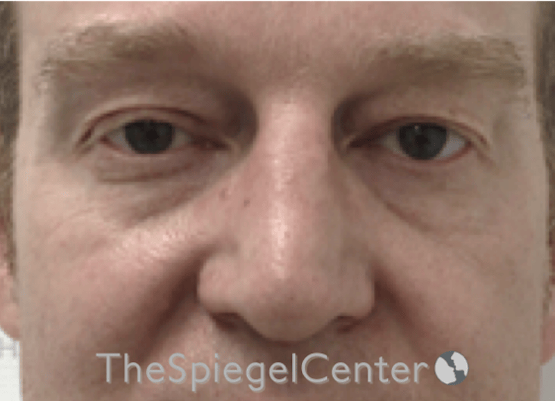 Blepharoplasty Before & After Gallery - Patient 331133 - Image 1