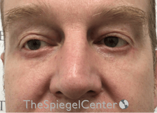 Blepharoplasty Before & After Gallery - Patient 331133 - Image 2