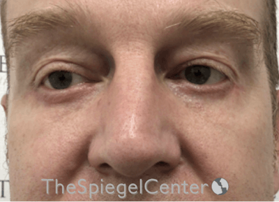 Blepharoplasty Before & After Gallery - Patient 331133 - Image 2