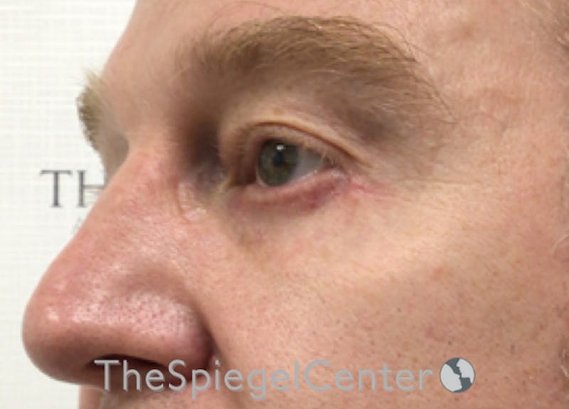 Blepharoplasty Before & After Gallery - Patient 331133 - Image 4
