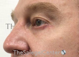 Blepharoplasty Before & After Gallery - Patient 331133 - Image 4