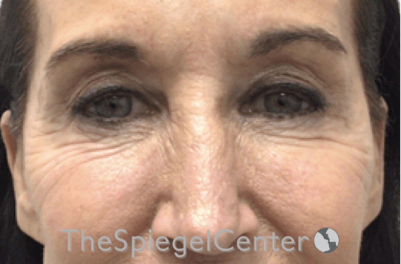 Blepharoplasty Before & After Gallery - Patient 809555 - Image 1