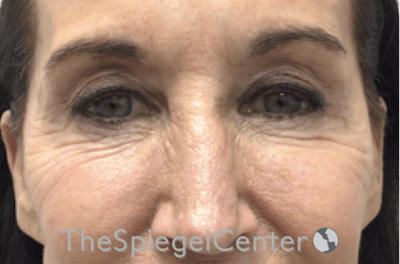 Blepharoplasty Before & After Gallery - Patient 809555 - Image 1
