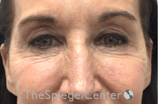 Blepharoplasty Before & After Gallery - Patient 809555 - Image 1