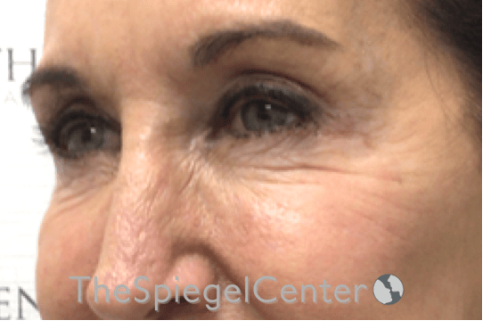 Blepharoplasty Before & After Gallery - Patient 809555 - Image 3