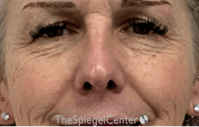 Blepharoplasty Before & After Gallery - Patient 231432 - Image 1