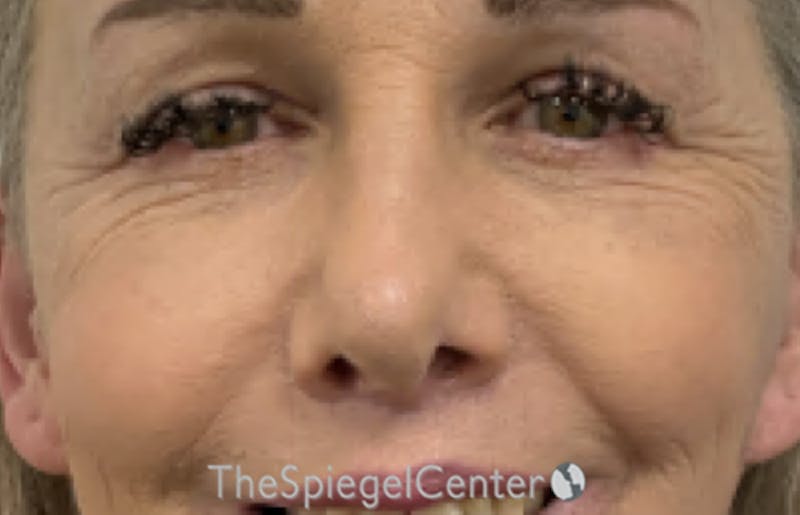 Blepharoplasty Before & After Gallery - Patient 231432 - Image 2
