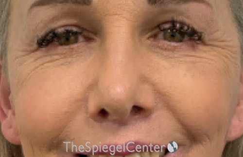 Blepharoplasty Before & After Gallery - Patient 231432 - Image 2