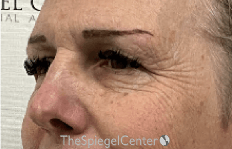 Blepharoplasty Before & After Gallery - Patient 231432 - Image 3