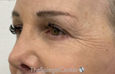 Blepharoplasty Before & After Gallery - Patient 231432 - Image 4