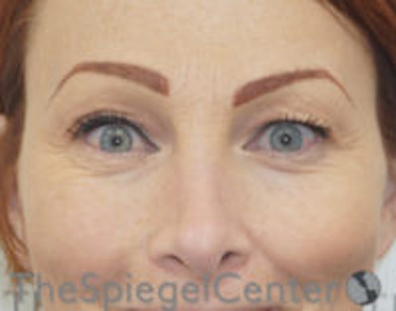 Blepharoplasty Before & After Gallery - Patient 809763 - Image 1