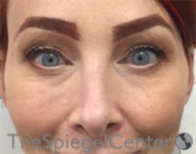 Blepharoplasty Before & After Gallery - Patient 809763 - Image 2