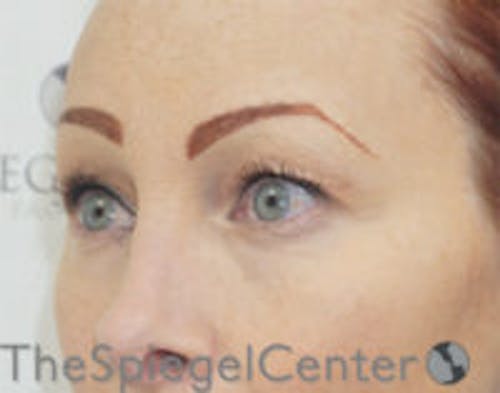 Blepharoplasty Before & After Gallery - Patient 809763 - Image 3